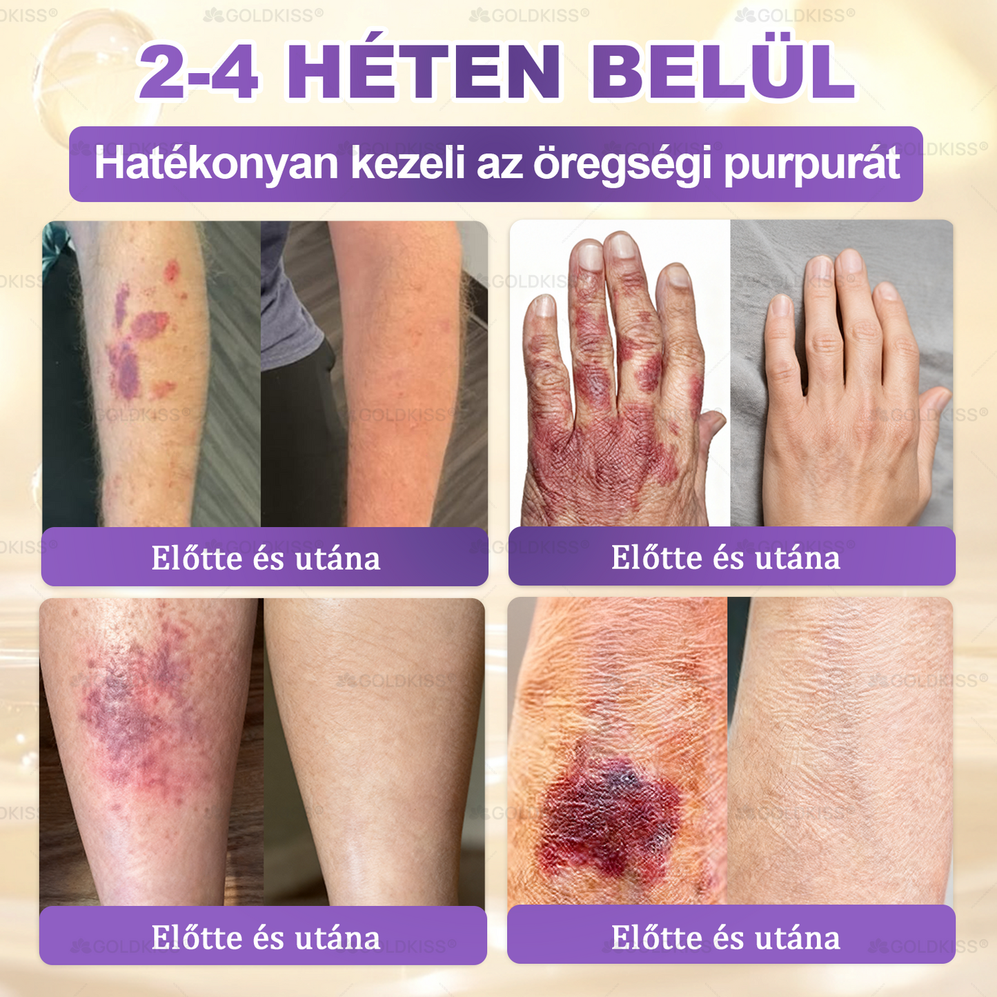𝐆𝐎𝐋𝐃𝐊𝐈𝐒𝐒® 🎁⏱️ Már csak 5 doboz maradt! További 50% kedvezményt kínálunk! Maradj fitt és egészséges. Ha most veszítesz, jövőre nem kapsz újabb esélyt.