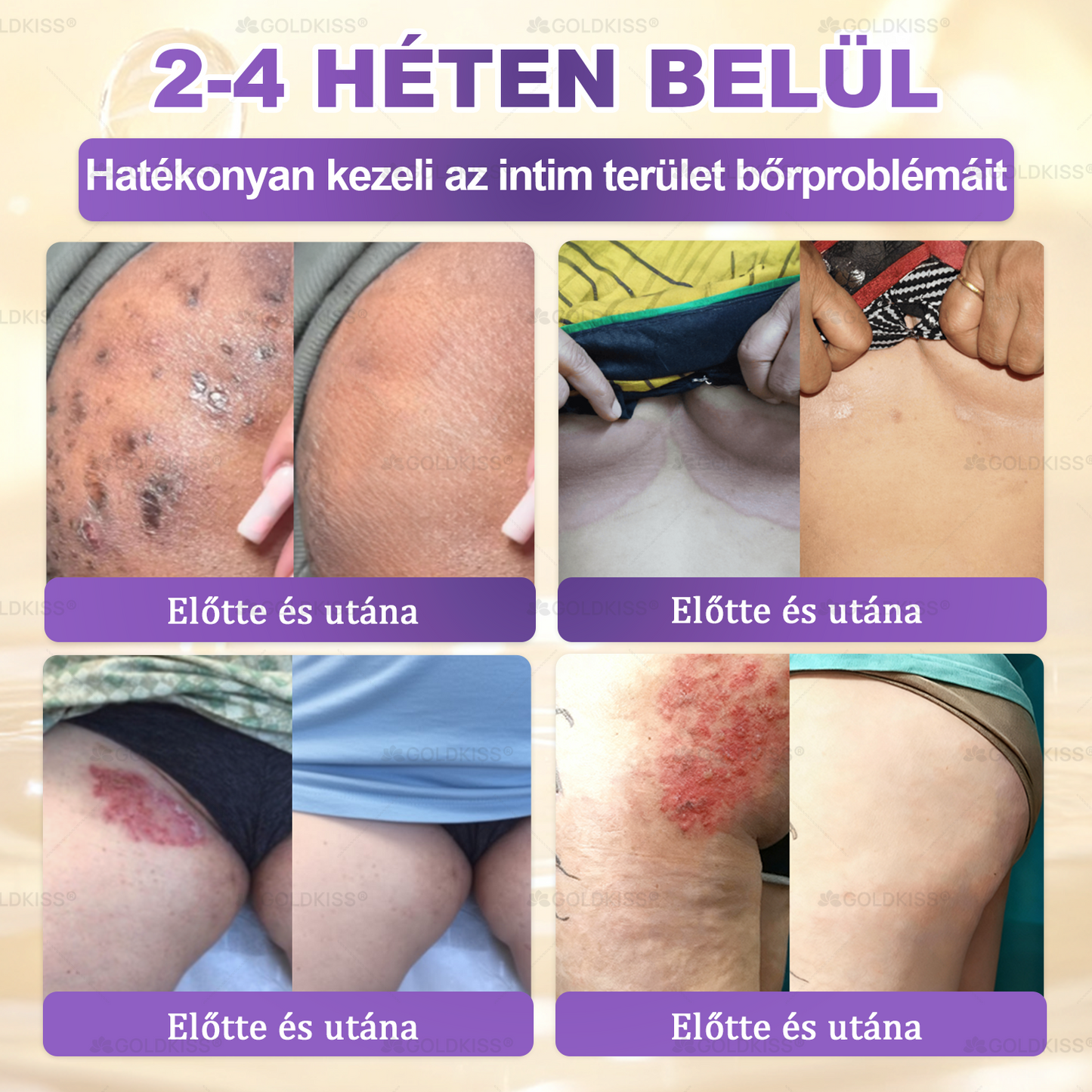 𝐆𝐎𝐋𝐃𝐊𝐈𝐒𝐒® 🎁⏱️ Már csak 5 doboz maradt! További 50% kedvezményt kínálunk! Maradj fitt és egészséges. Ha most veszítesz, jövőre nem kapsz újabb esélyt.