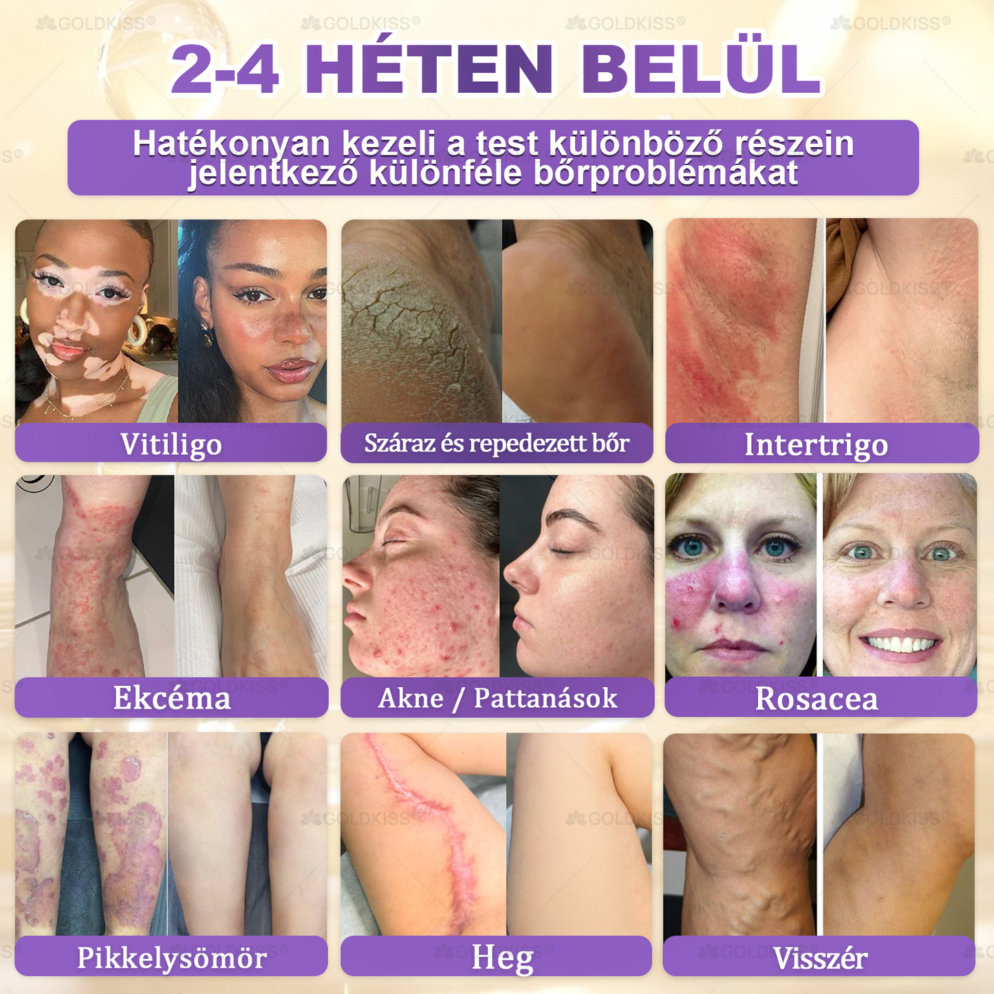 𝐆𝐎𝐋𝐃𝐊𝐈𝐒𝐒® 🎁⏱️ Már csak 5 doboz maradt! További 50% kedvezményt kínálunk! Maradj fitt és egészséges. Ha most veszítesz, jövőre nem kapsz újabb esélyt.