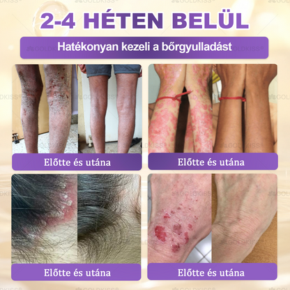 𝐆𝐎𝐋𝐃𝐊𝐈𝐒𝐒® 🎁⏱️ Már csak 5 doboz maradt! További 50% kedvezményt kínálunk! Maradj fitt és egészséges. Ha most veszítesz, jövőre nem kapsz újabb esélyt.
