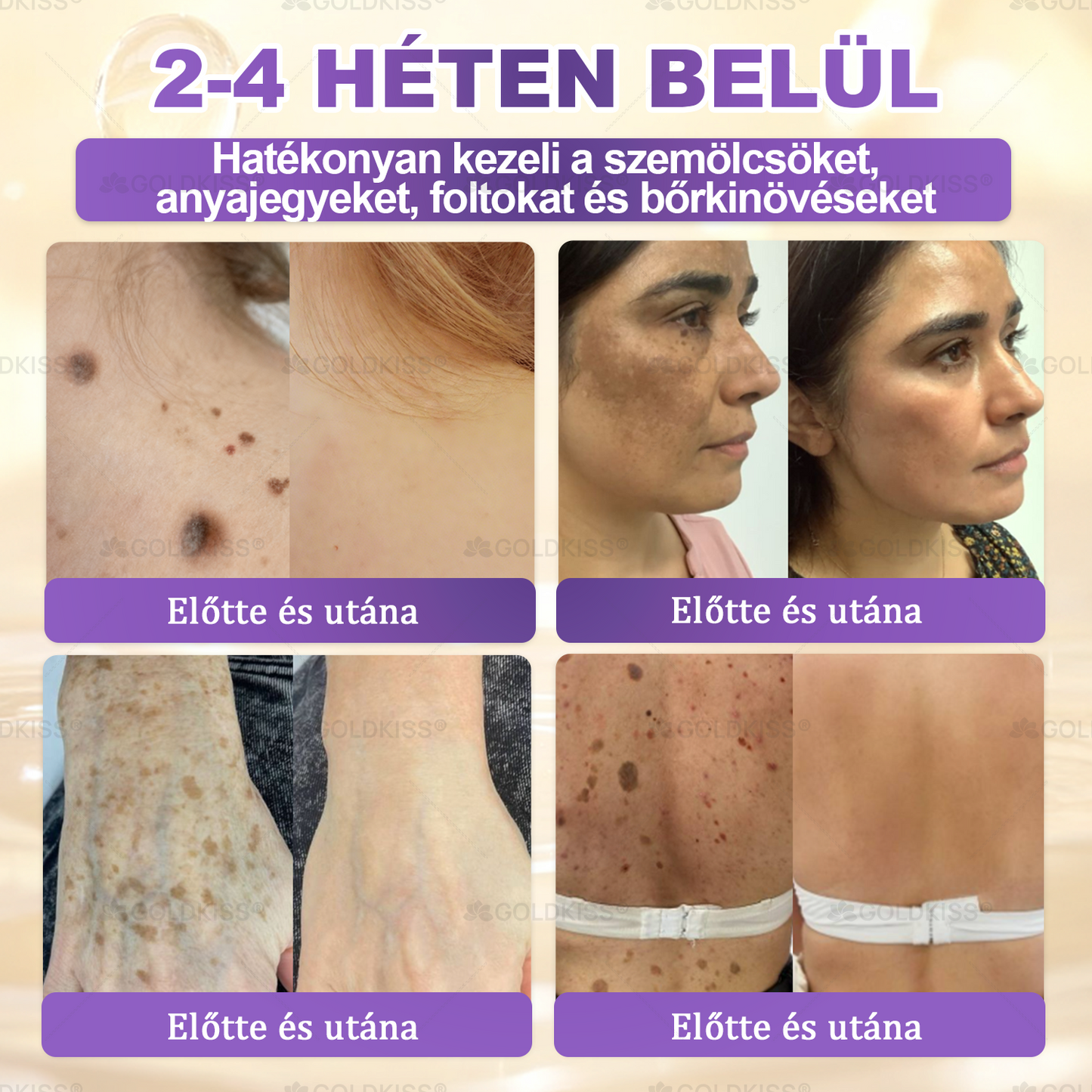𝐆𝐎𝐋𝐃𝐊𝐈𝐒𝐒® 🎁⏱️ Már csak 5 doboz maradt! További 50% kedvezményt kínálunk! Maradj fitt és egészséges. Ha most veszítesz, jövőre nem kapsz újabb esélyt.