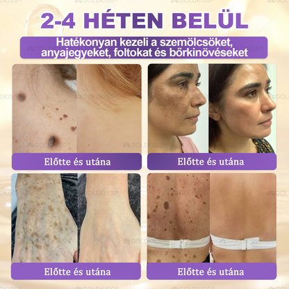 𝐆𝐎𝐋𝐃𝐊𝐈𝐒𝐒® 🎁⏱️ Már csak 5 doboz maradt! További 50% kedvezményt kínálunk! Maradj fitt és egészséges. Ha most veszítesz, jövőre nem kapsz újabb esélyt.